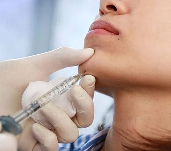 Çene Dolgusu ve Jawline Dolgusu ile Yüz Hatlarında Netlik