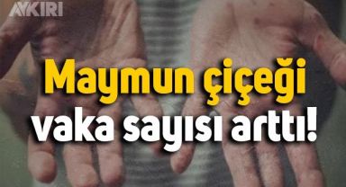 Türkiye'de maymun çiçeği vaka sayısı arttı: Fahrettin Koca vaka sayısını açıkladı