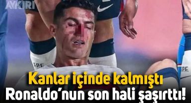 Milli maçta sakatlanan Cristiano Ronaldo’nun yüzündeki morluklar dikkat çekti