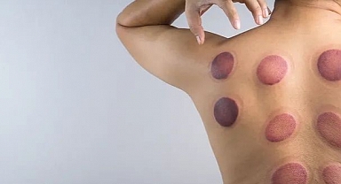 Uzmanlar uyardı: Hacamat tedavisi hayatınızı kabusa çevirebilir!