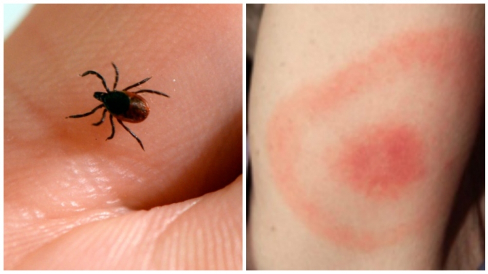 Uzmanlar Lyme için uyardı! Belirtileri nelerdir, ne yapılmalı? 2