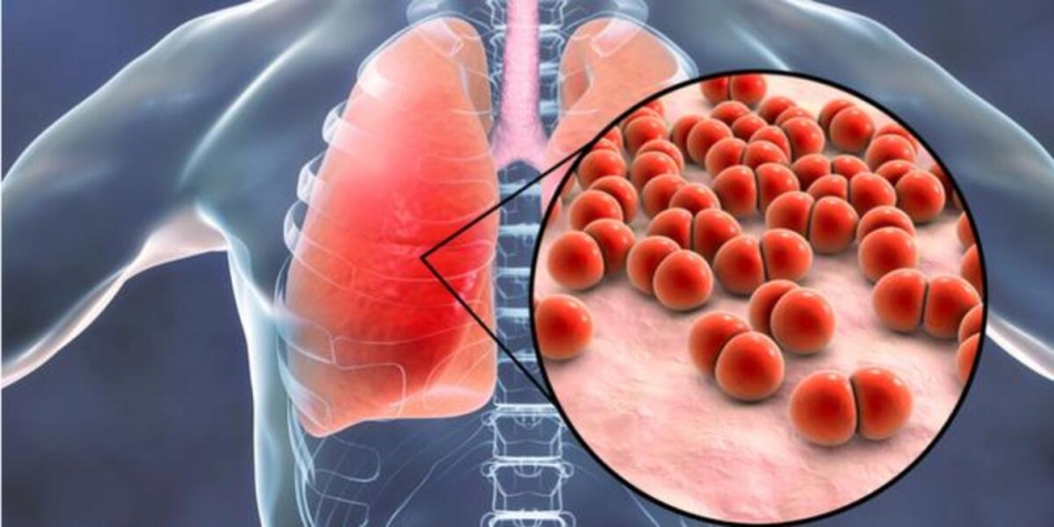 Zatürre nedir? Zatürre aşısı Covid-19 tedavisinde kullanılabilir mi? 2
