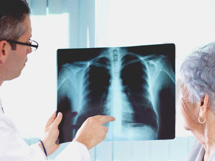 Zatürre nedir? Zatürre aşısı Covid-19 tedavisinde kullanılabilir mi? 4